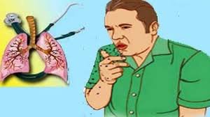 दवा से परे टीबी का उपचार